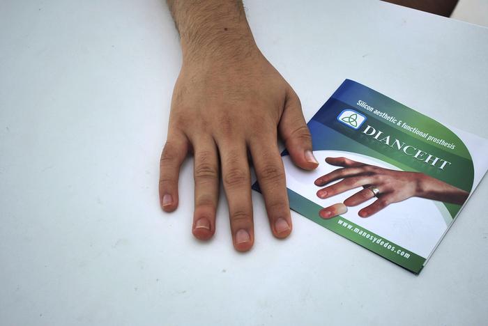 Finger prosthesis